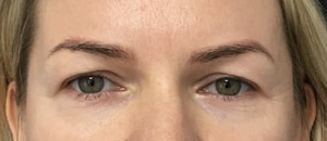blepharoplasty clinic liverpool