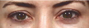 blepharoplasty