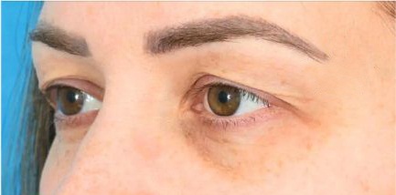 Blepharoplasty in Liverpool