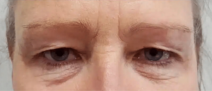 blepharoplasty in liverpool