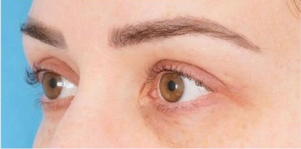 Blepharoplasty Liverpool