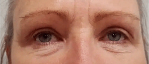 blepharoplasty liverpool