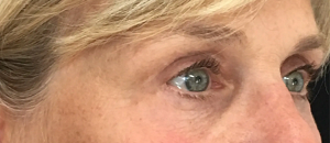 eye bag removal liverpool