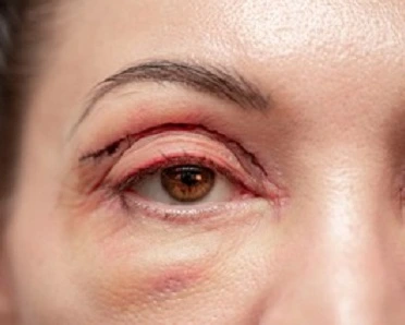 Eyelid Surgery Liverpool