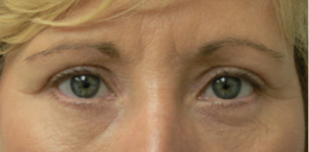 Eyelid