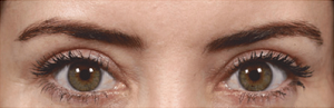 lower blepharoplasty