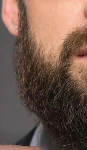 beard transplant surgery in Liverpool