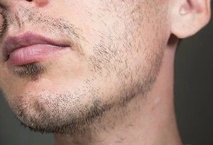 beard transplant surgery liverpool