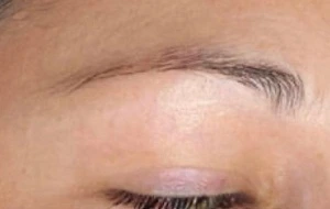 eyebrow hair transplant liverpool