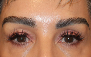 eyebrow restoration