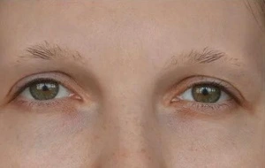 eyebrow transplant cost liverpool