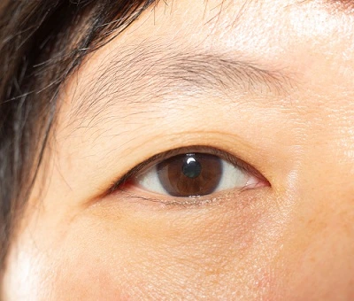 eyebrow transplant surgery