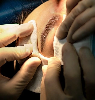 eyebrow transplant