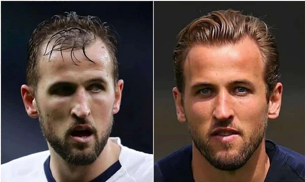 harry kane hair transplant