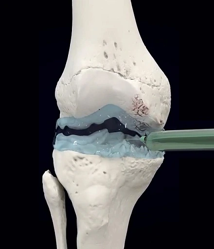 arthrosamid knee injection