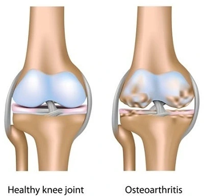 Arthrosamid Liverpool Knee injections for Arthritis diagram on joint pain