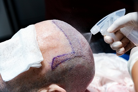 FUE Hair Transplant Liverpool