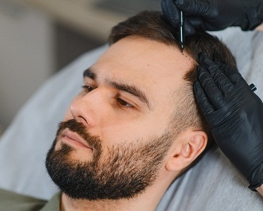 hair transplant Liverpool