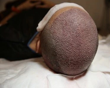 hair transplant