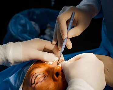 upper eyelid surgery liverpool